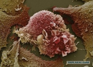пораженные раком клетки